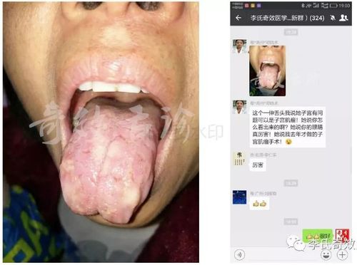 新澳天天开奖资料大全正版和舌根和牙龈被缝一起与舌根和牙龈被缝一起怎么办